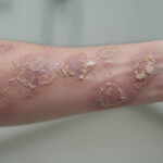 découvrez ce qu'est la dermatophilose chez l'humain, ses causes, ses symptômes et comment poser un diagnostic précis pour une prise en charge efficace.